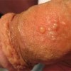生殖器疱疹存在一定的并发症