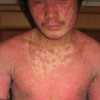 牛皮癣反复发作有什么原因
