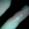 皮肤湿疹发病的因素有哪些