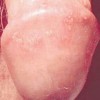 介绍生殖器疱疹的护理方法