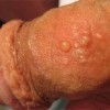 感染生殖器疱疹后如何护理
