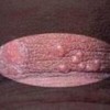 原发性生殖器疱疹的护理