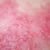生殖器疱疹治愈后怎么护理