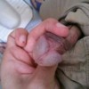 治愈生殖器疱疹护理常识很重要