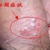 生殖器疱疹的预防护理
