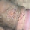生殖器疱疹日常饮食需要注意些什么