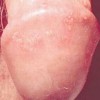 生殖器疱疹的饮食有哪些要求