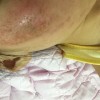 到底怎样治湿疹恢复的快