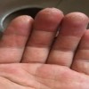 婴儿湿疹的常见误区有哪些