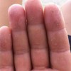 手癣应和其他哪些疾病鉴别