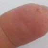 手癣有哪些主要类型