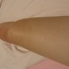 乳房湿疹病如何治疗呢