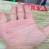 婴儿湿疹怎么治疗好