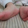 手足癣及甲癣的病因及护理