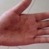 足癣患者治疗期间如何护理