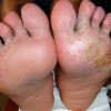 手足癣患者的饮食护理怎么做