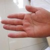 手足癣应如何护理