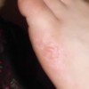 手足癣患者的家庭护理