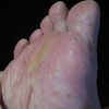 手足癣的日常护理有哪些禁忌