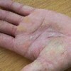 手足癣患者的最佳护理措施