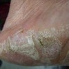手足癣患者如何做好护理