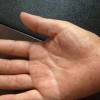 手足癣患者要怎么护理最有效