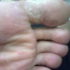 专家教你如何鉴别诊断手足癣