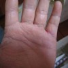 手足癣的发生需要怎样来诊断