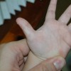 手足皲裂是什么病呢