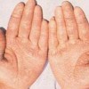 手足皲裂的临床症状