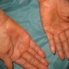手足皲裂症状的预防说明