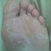 手足癣患者在日常生活中的饮食调理方法