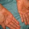 手足皲裂的症状及治疗