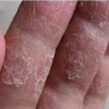 手足癣患者应做好预防治疗工作