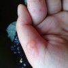 手足癣发病的病因是什么