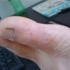 怎样可以预防手足癣的出现