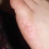 医生教你预防手足癣