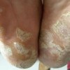 手足癣的病因症状是什么