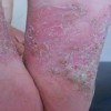 怎样预防手足癣