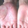 手足癣都有哪些病因
