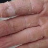 手足癣的病因