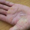 手足癣的病因都有哪些