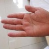 手足癣的预防保健方法有什么