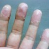 换季应注意预防手足癣