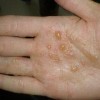 预防手足癣的注意事项是什么