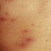 水痘的症状及防护有哪些？