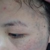 太田痣的诊断方法有什么