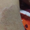 自己如何才能诊断体癣