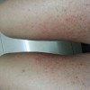体癣要如何鉴别诊断呢？