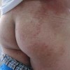 体癣和股癣的诊断和处理要点